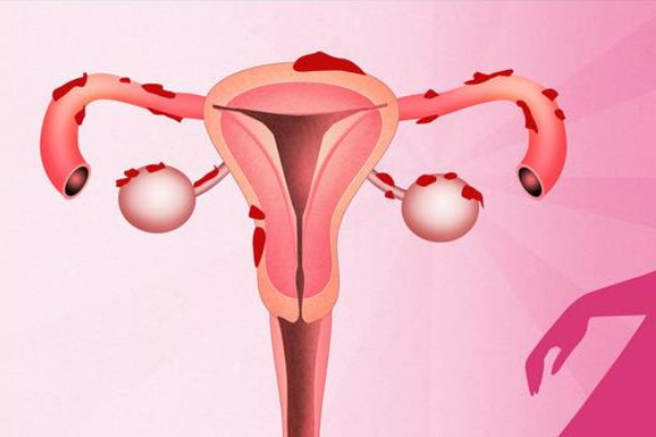 出现这4种症状，你可能得了子宫内膜炎！不及时治疗会不孕