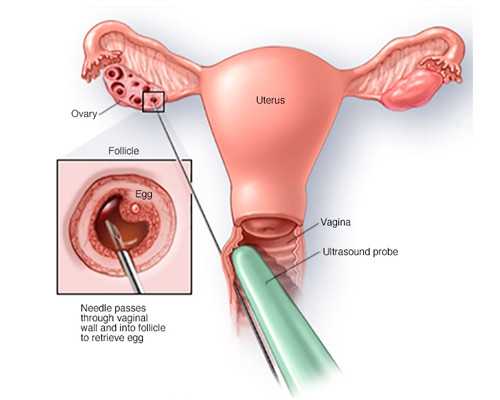 哪些女性适合进行试管助孕？解析不明原因不孕的助孕供卵成功率
