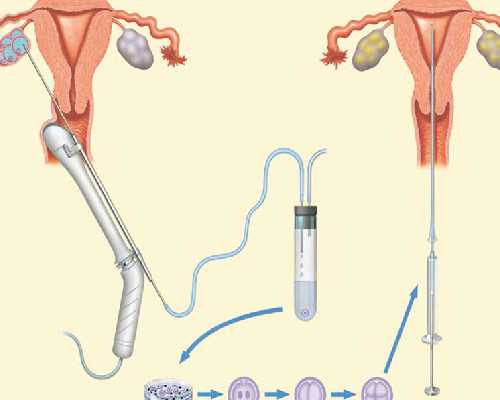 探寻北京辅助生殖：成功因素、流程与费用解析