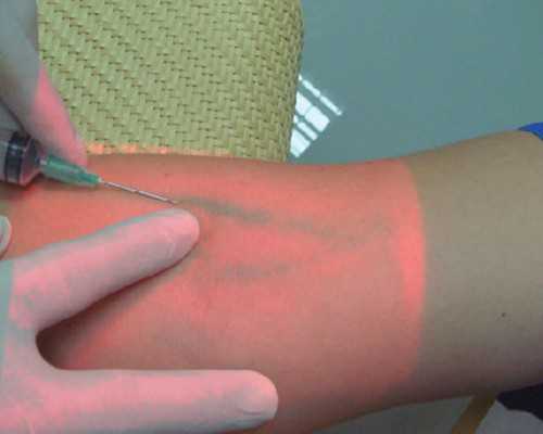 试管助孕分娩方式解析：顺产还是剖腹产？